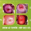tong-hop-cac-thong-tin-lien-quan-toi-benh-viem-lo-tuyen-do-1